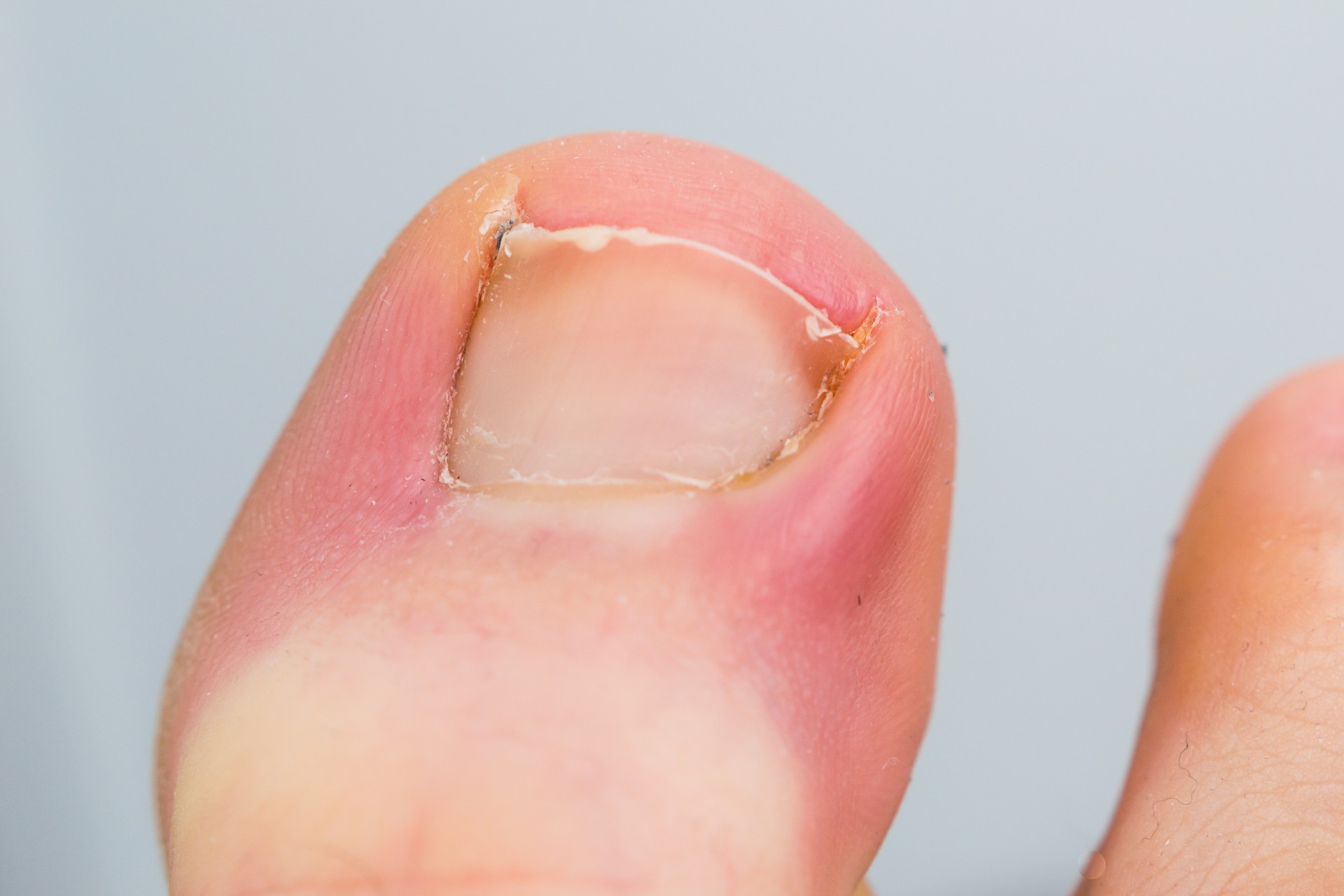 a big toe with an ingrown toenail